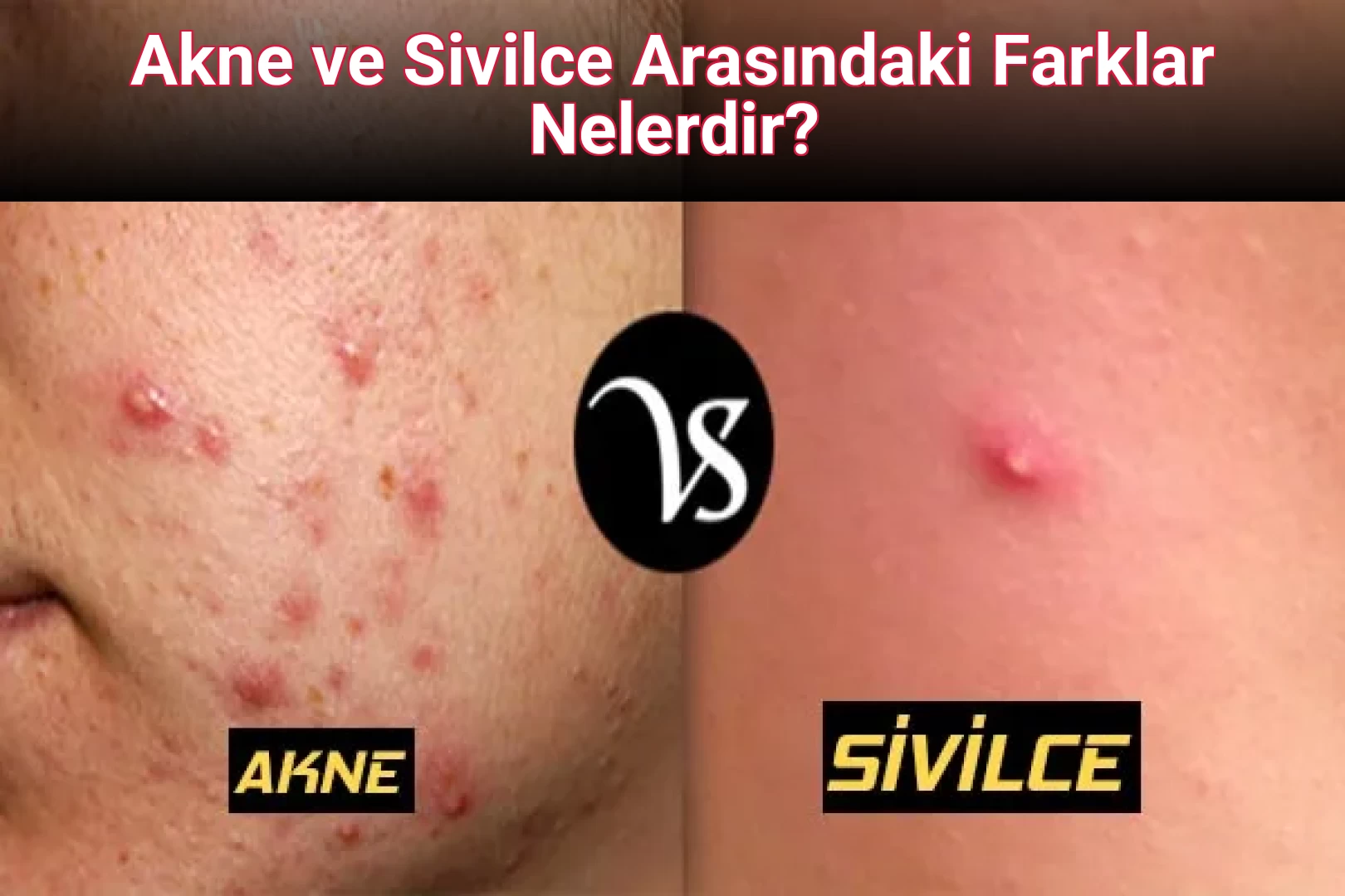 Akne ve Sivilce Arasındaki Farklar Nelerdir?