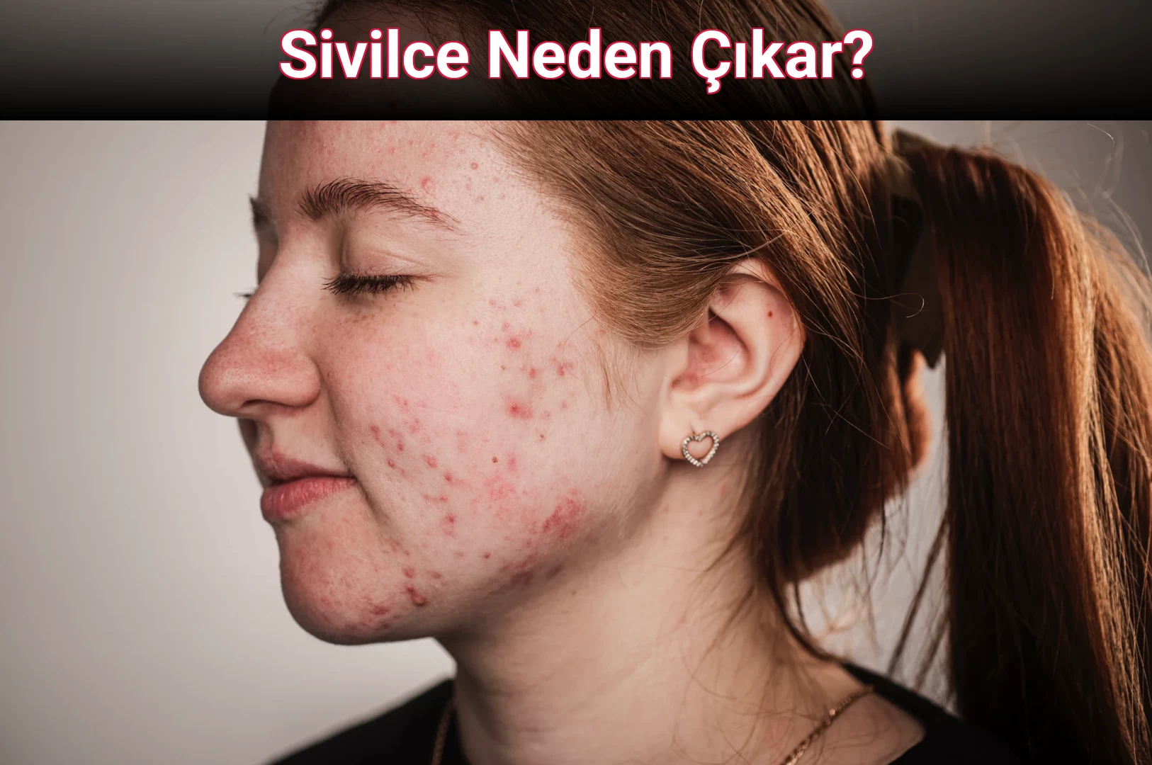 Sivilce Neden Çıkar?