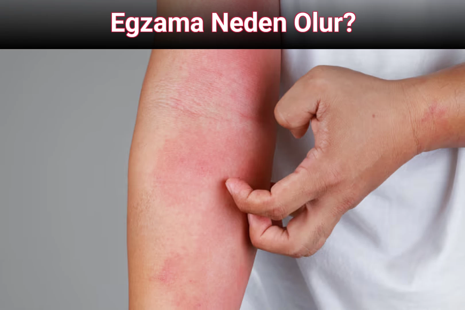 Egzama Neden Olur?