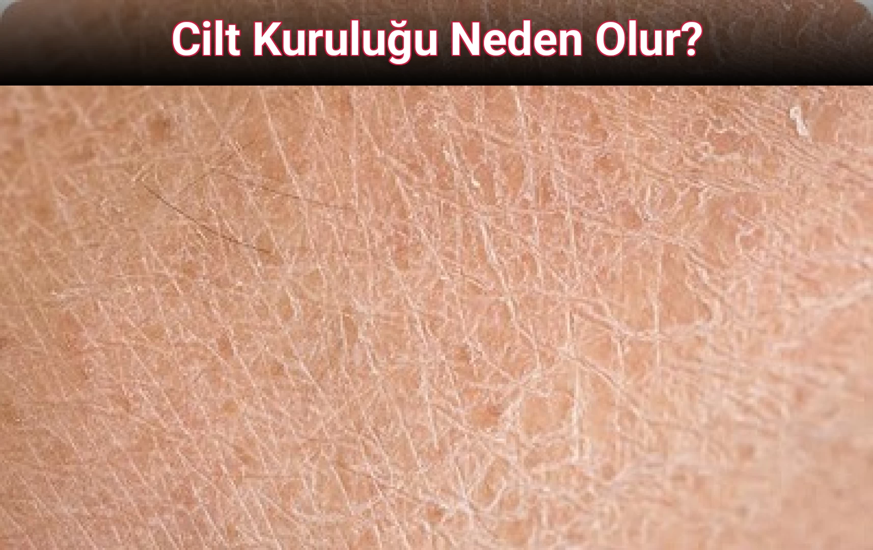 Cilt Kuruluğu Neden Olur?