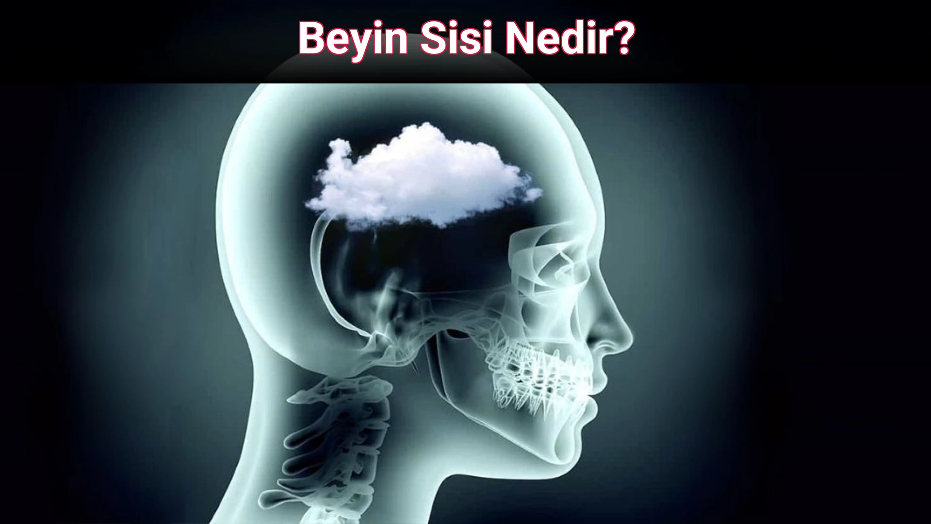Beyin Sisi Nedir?