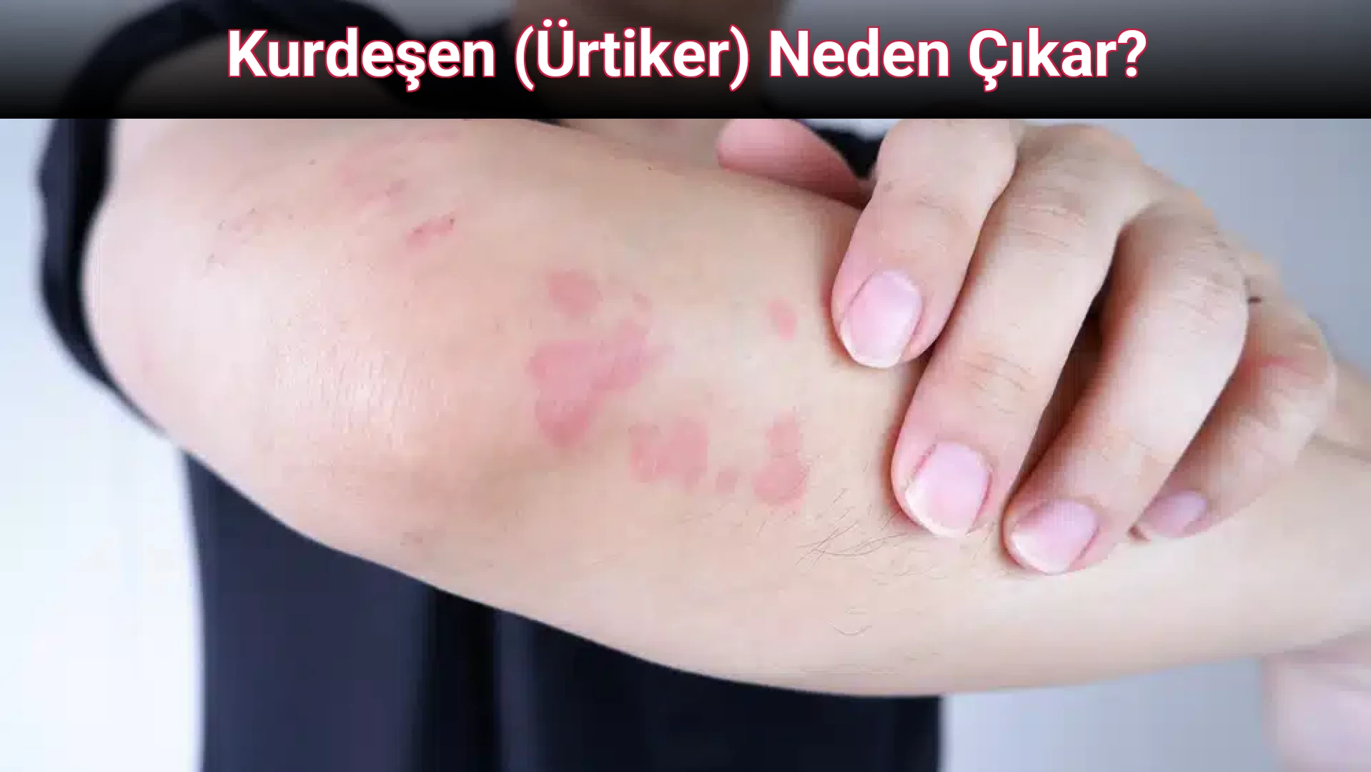 Kurdeşen (Ürtiker) Neden Çıkar?