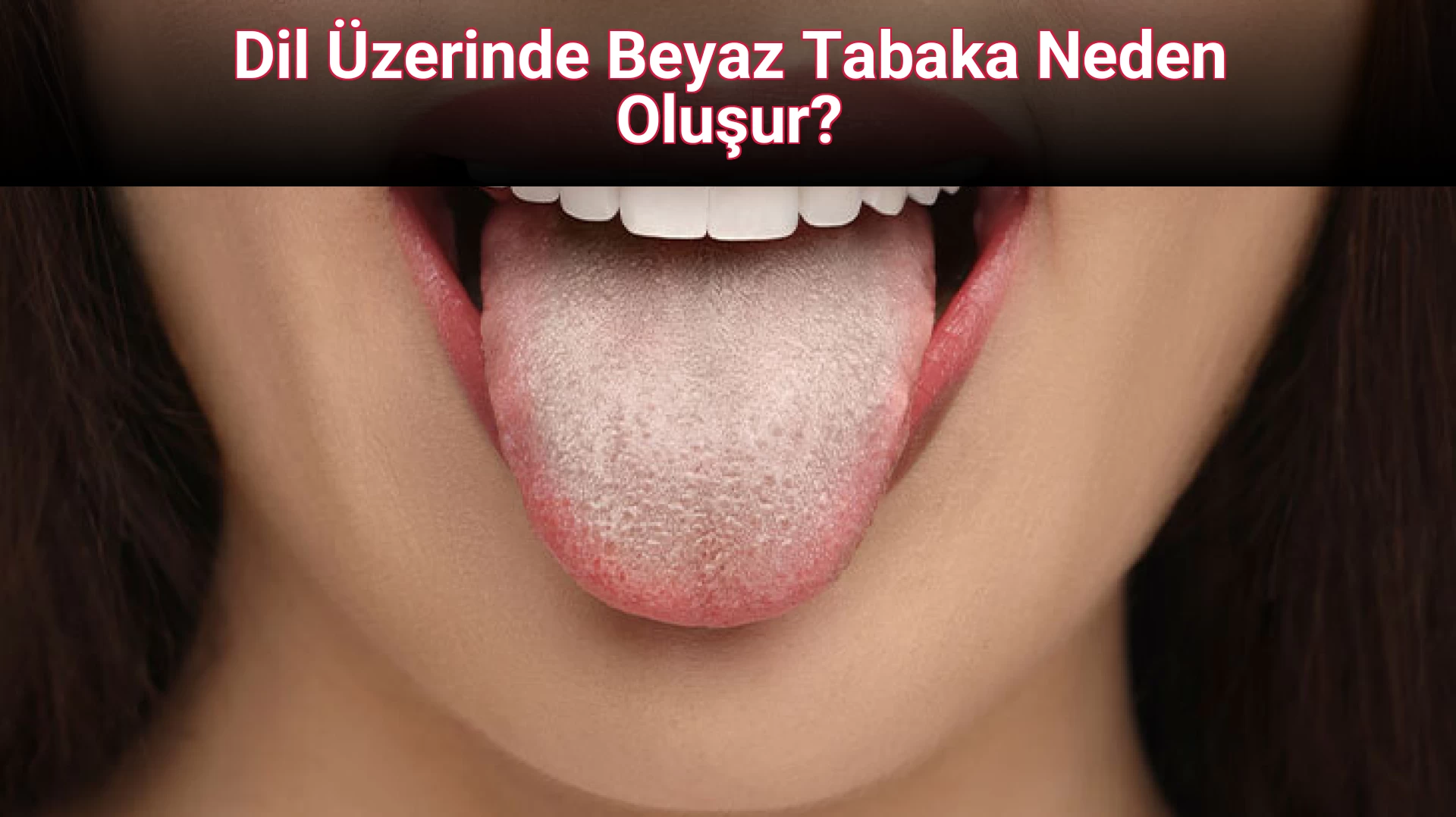 Dil Üzerinde Beyaz Tabaka Neden Oluşur?