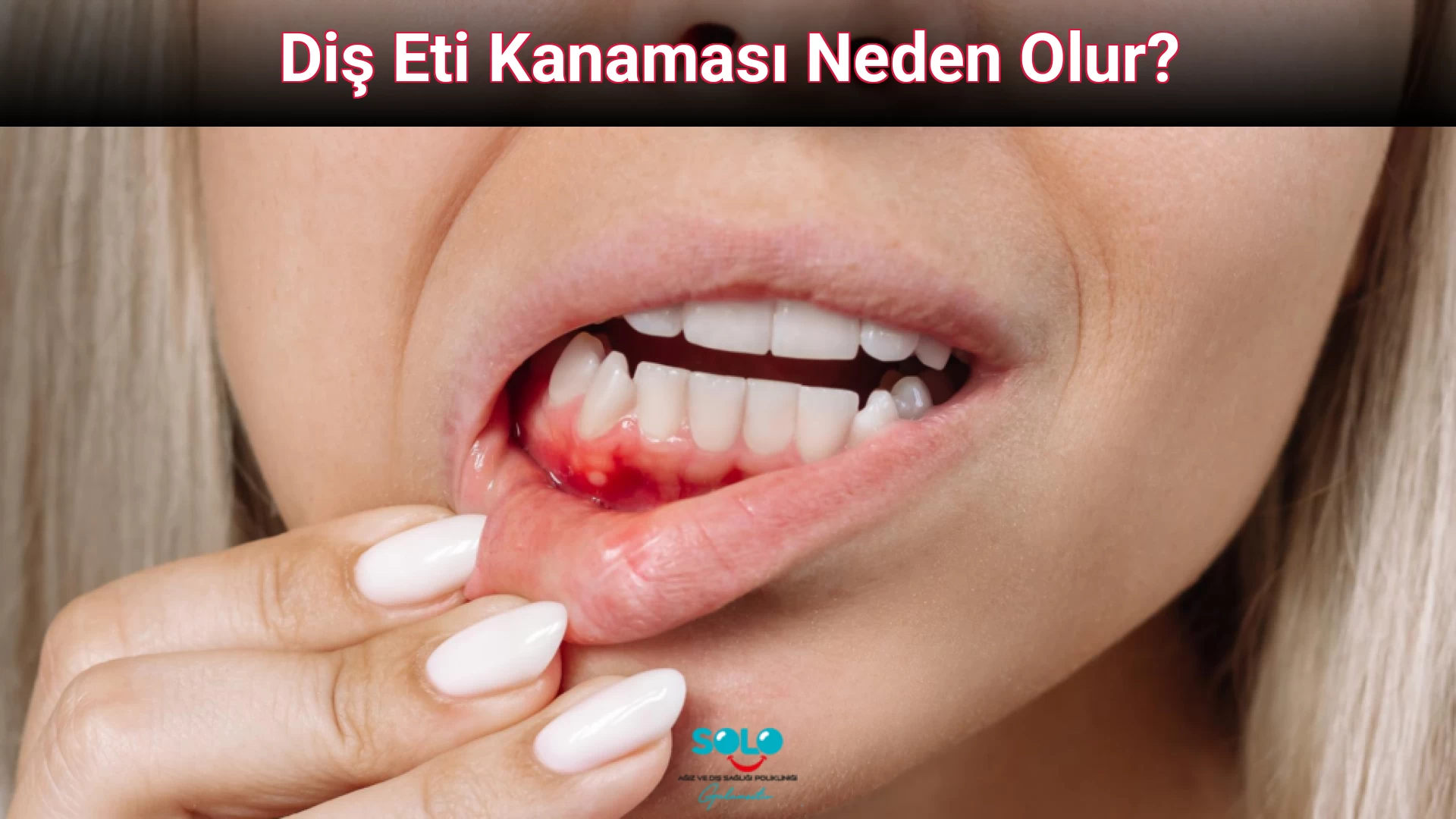 Diş Eti Kanaması Neden Olur?