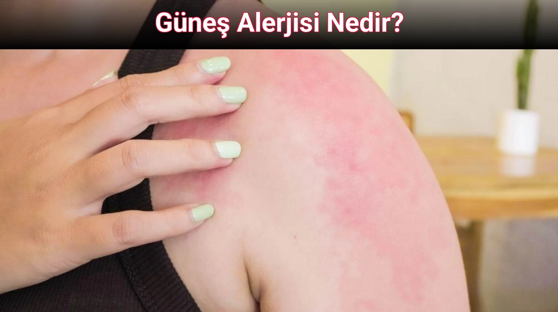 Güneş Alerjisi Nedir?