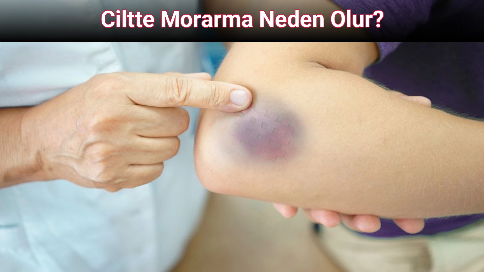 Ciltte Morarma Neden Olur?