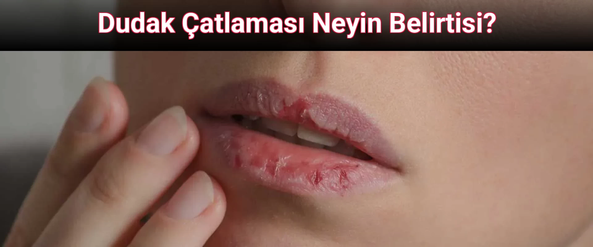 Dudak Çatlaması Neyin Belirtisi?