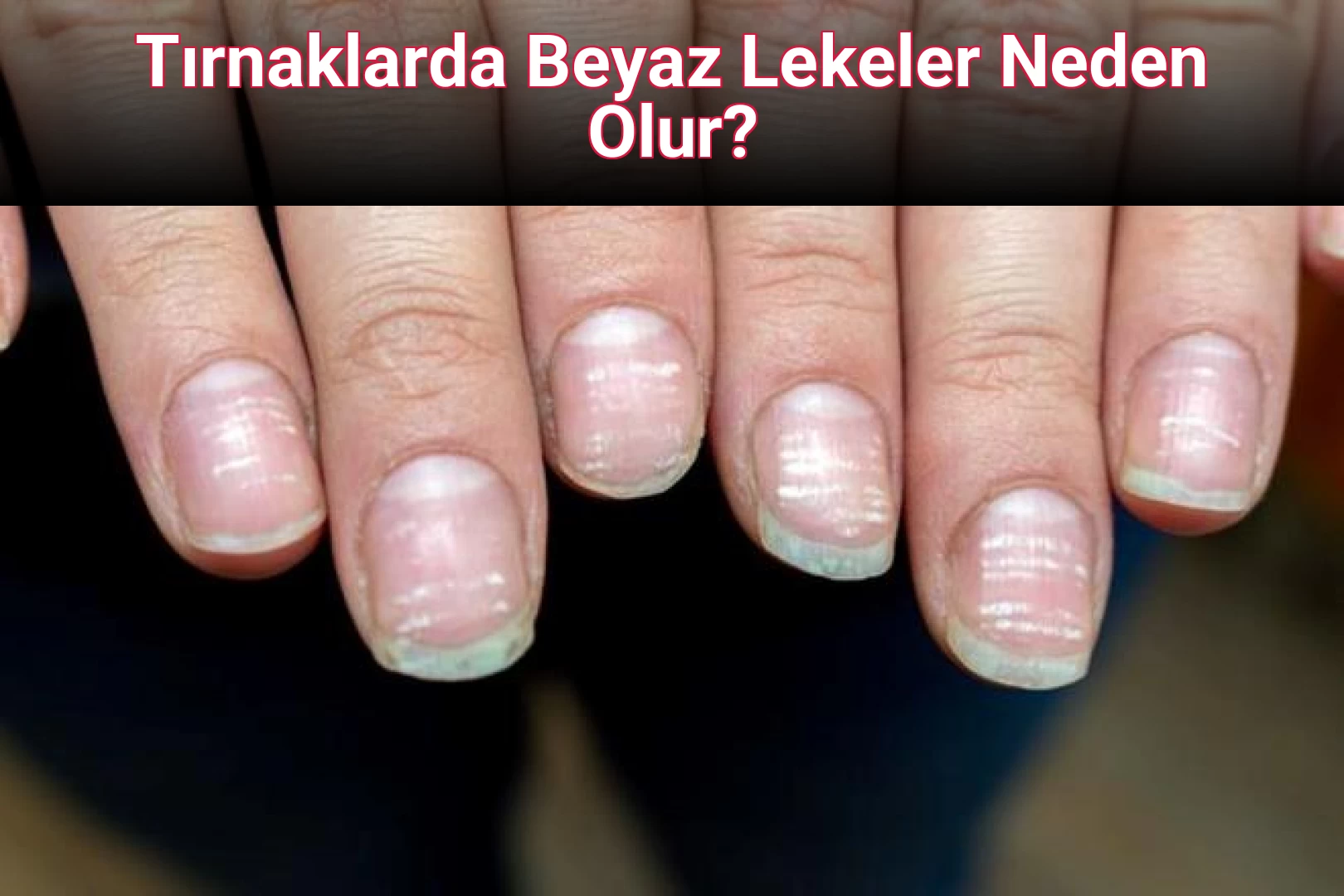 Tırnaklarda Beyaz Lekeler Neden Olur?