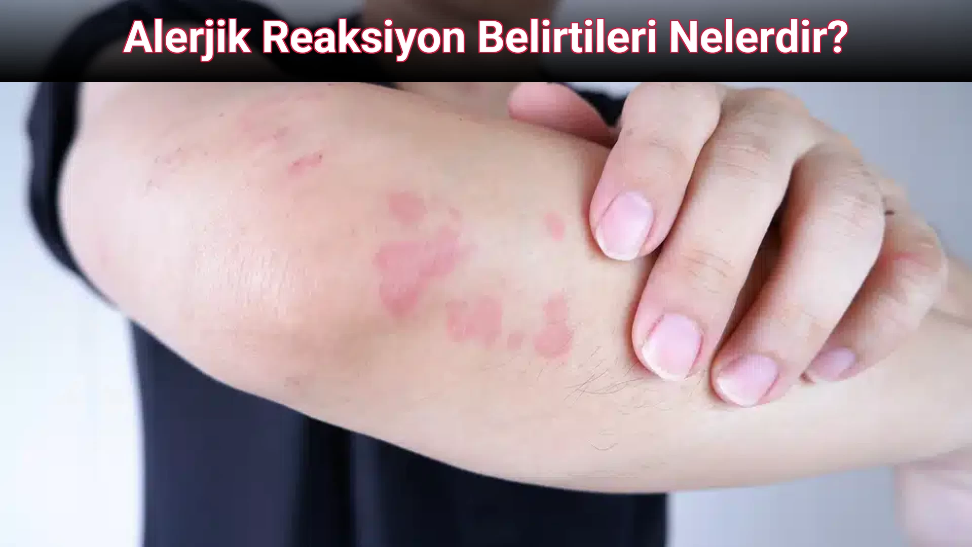 Alerjik Reaksiyon Belirtileri Nelerdir?