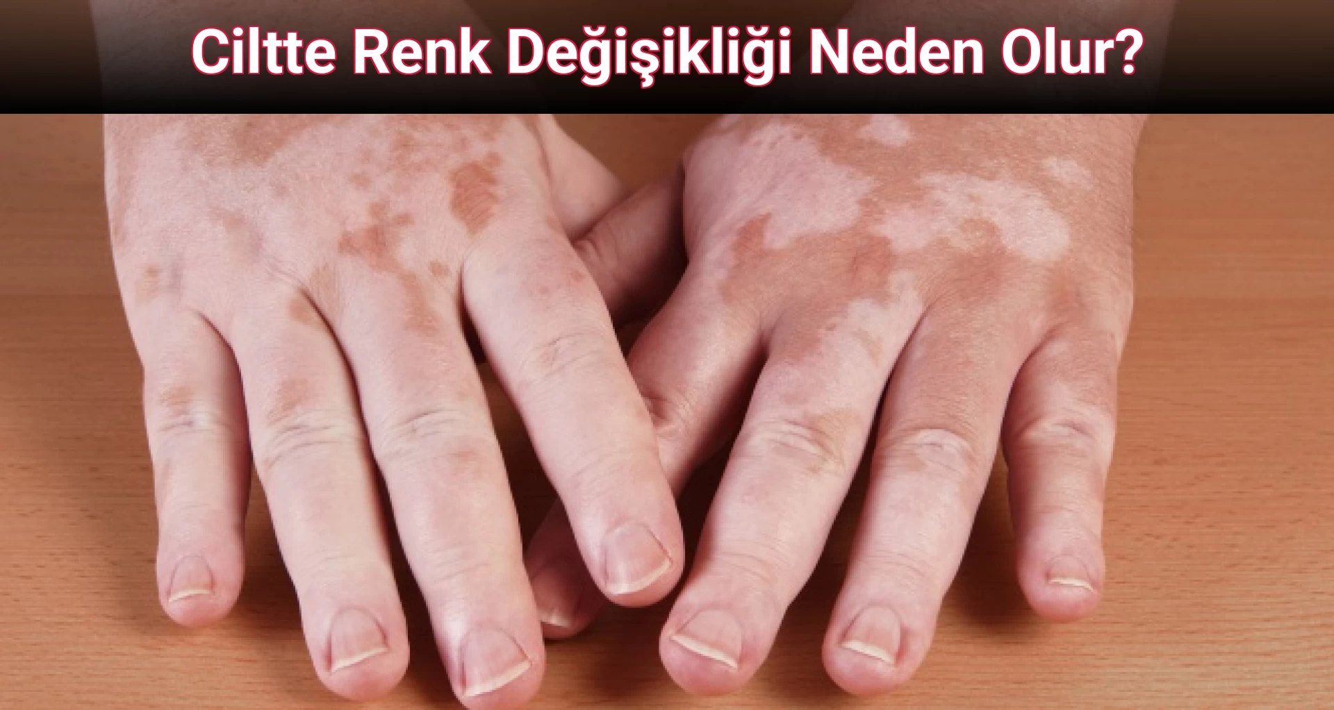 Ciltte Renk Değişikliği Neden Olur?