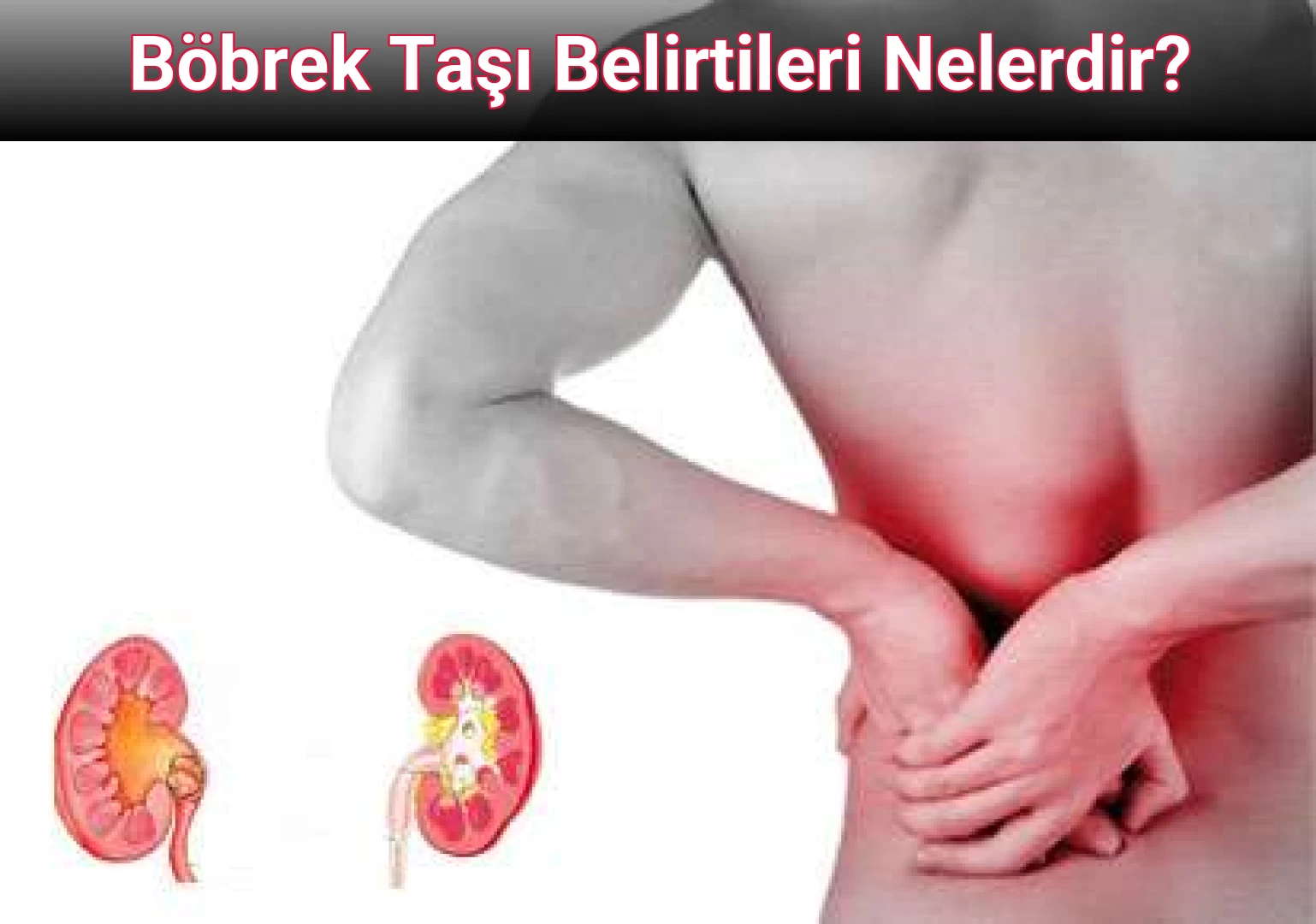 Böbrek Taşı Belirtileri Nelerdir?