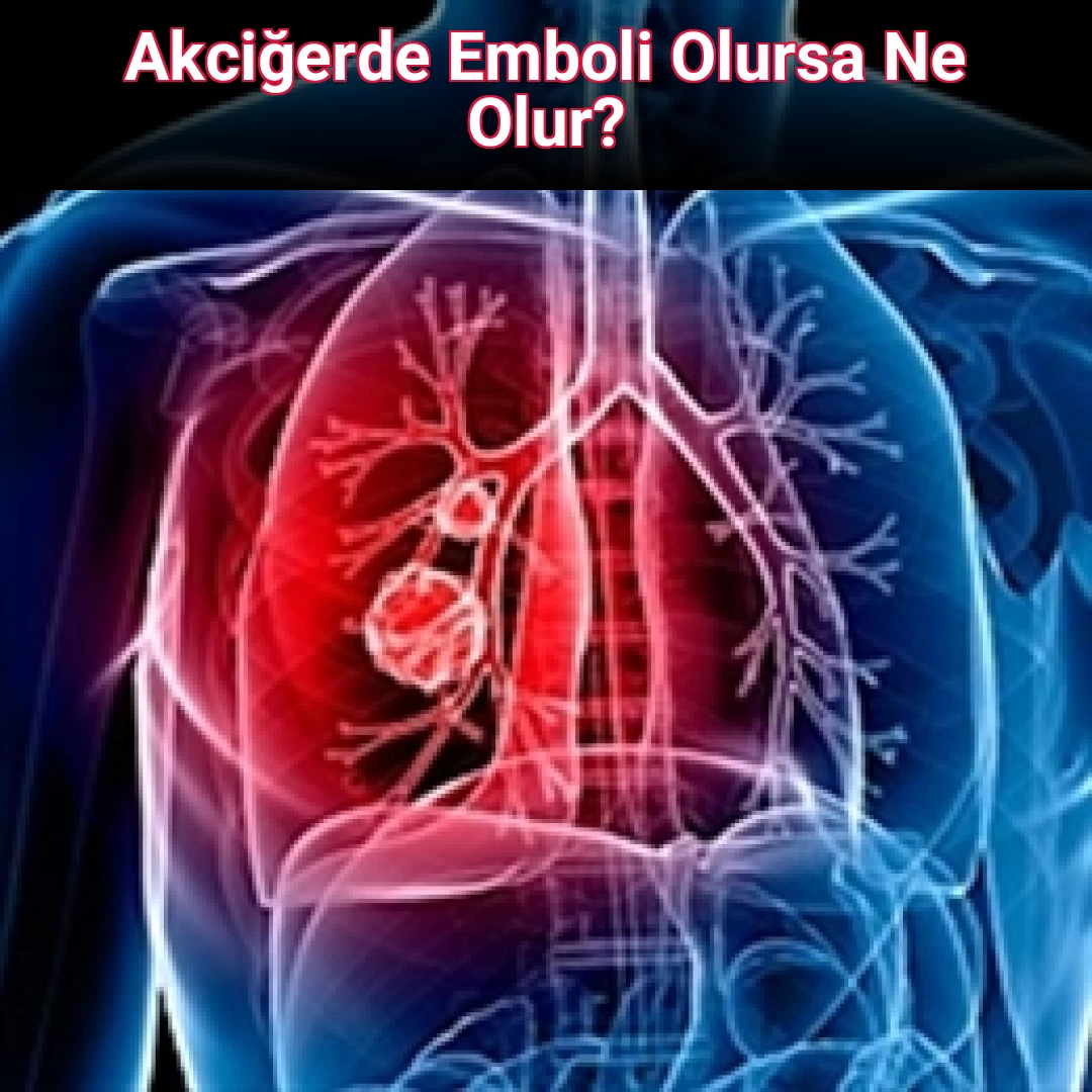 Akciğerde Emboli Olursa Ne Olur?
