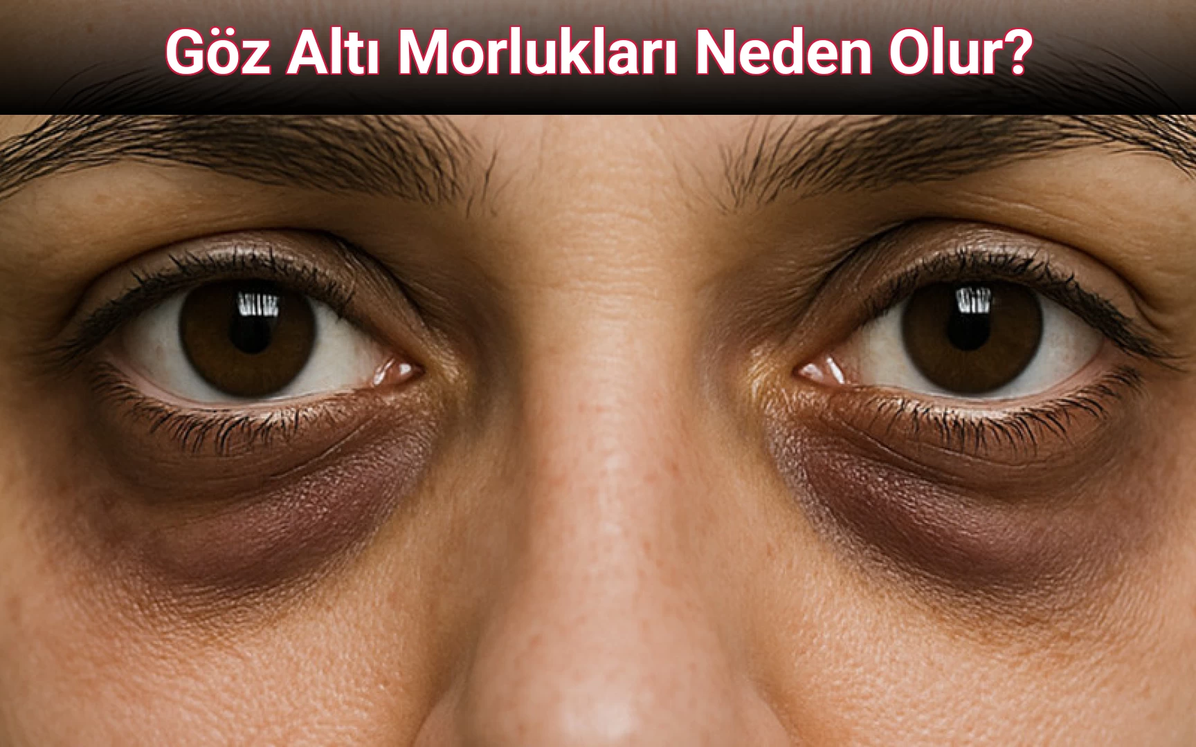 Göz Altı Morlukları Neden Olur?