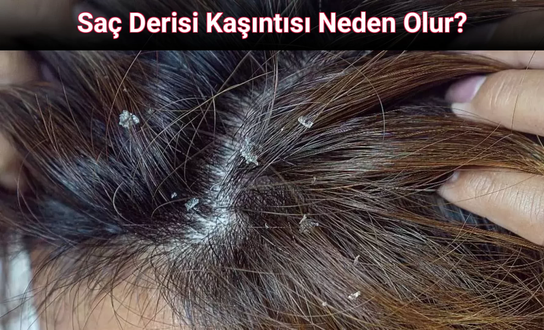 Saç Derisi Kaşıntısı Neden Olur?