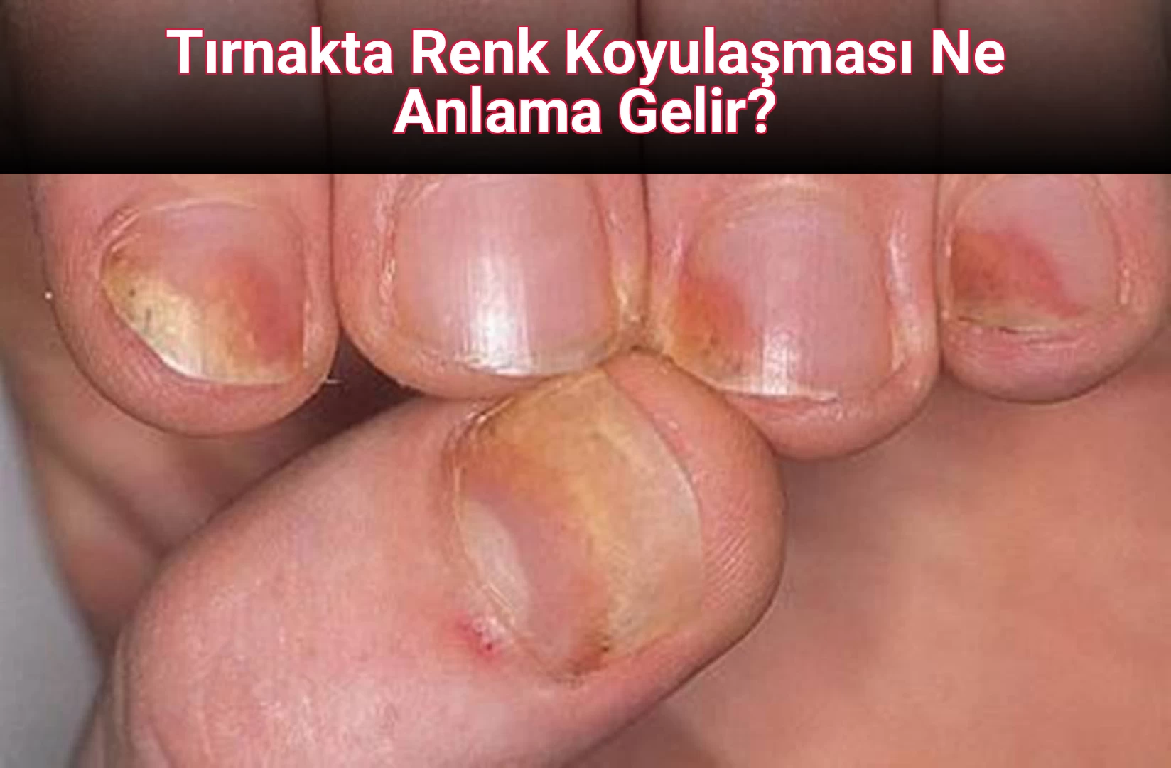 Tırnakta Renk Koyulaşması Ne Anlama Gelir?
