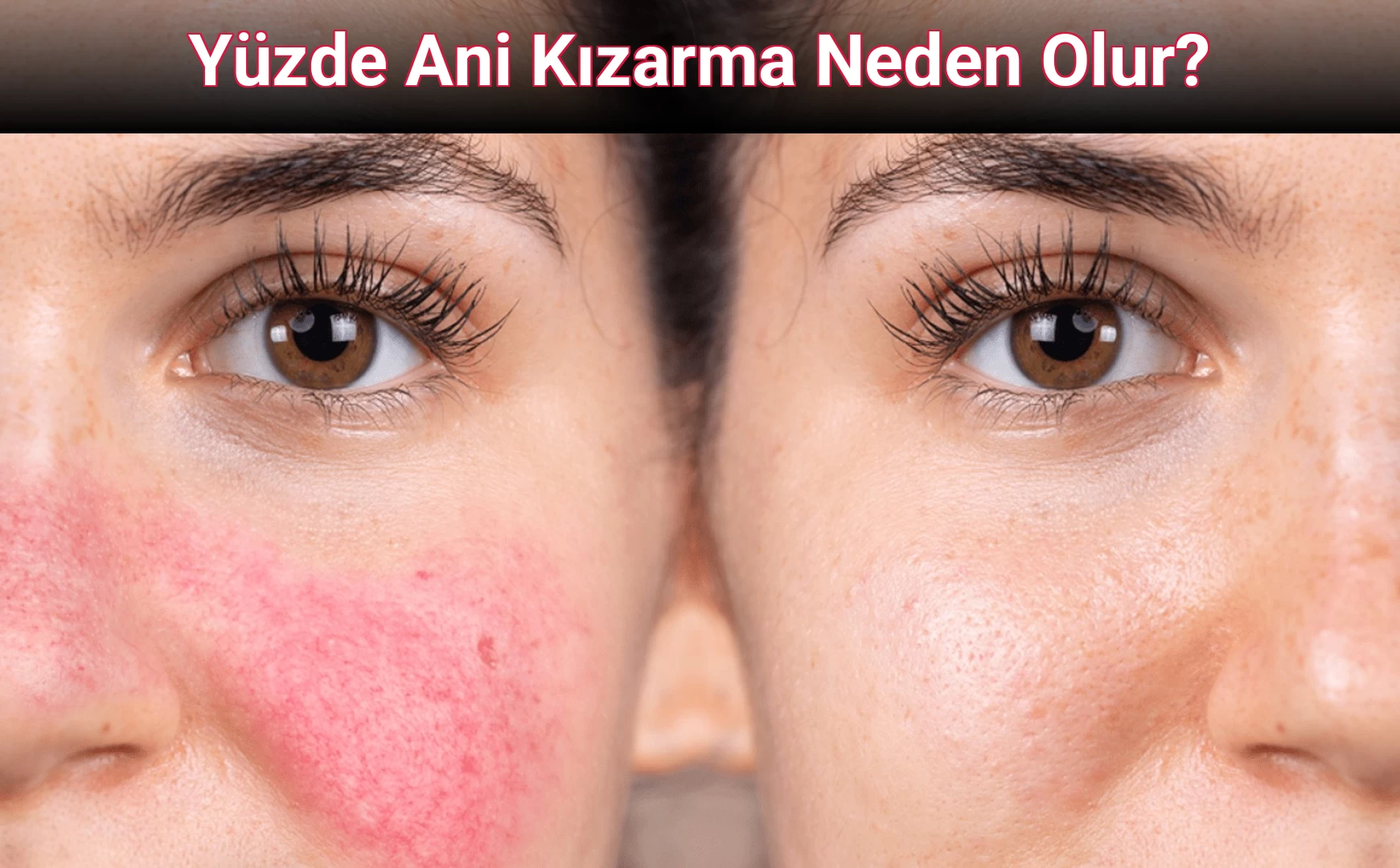 Yüzde Ani Kızarma Neden Olur?