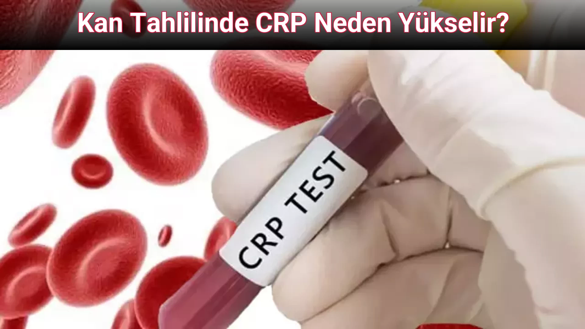 Kan Tahlilinde CRP Neden Yükselir?