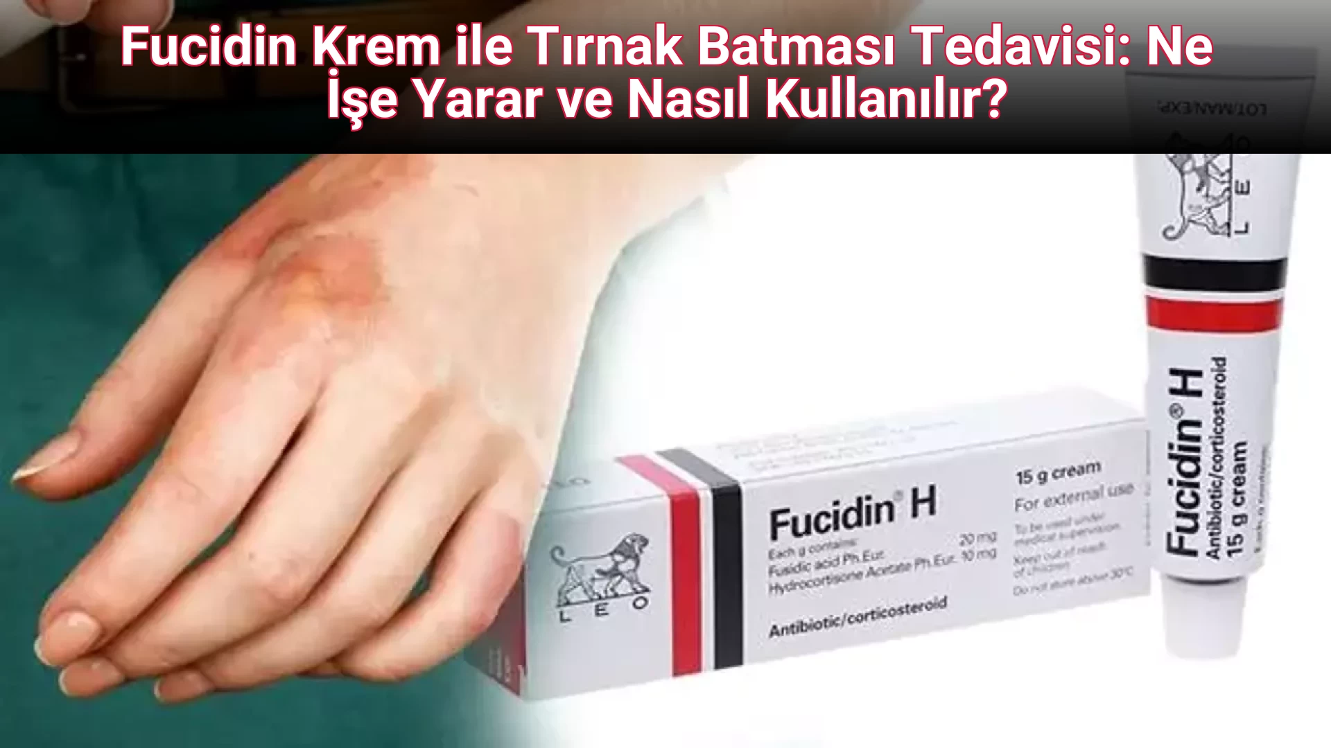 Fucidin Krem ile Tırnak Batması Tedavisi: Ne İşe Yarar ve Nasıl Kullanılır?