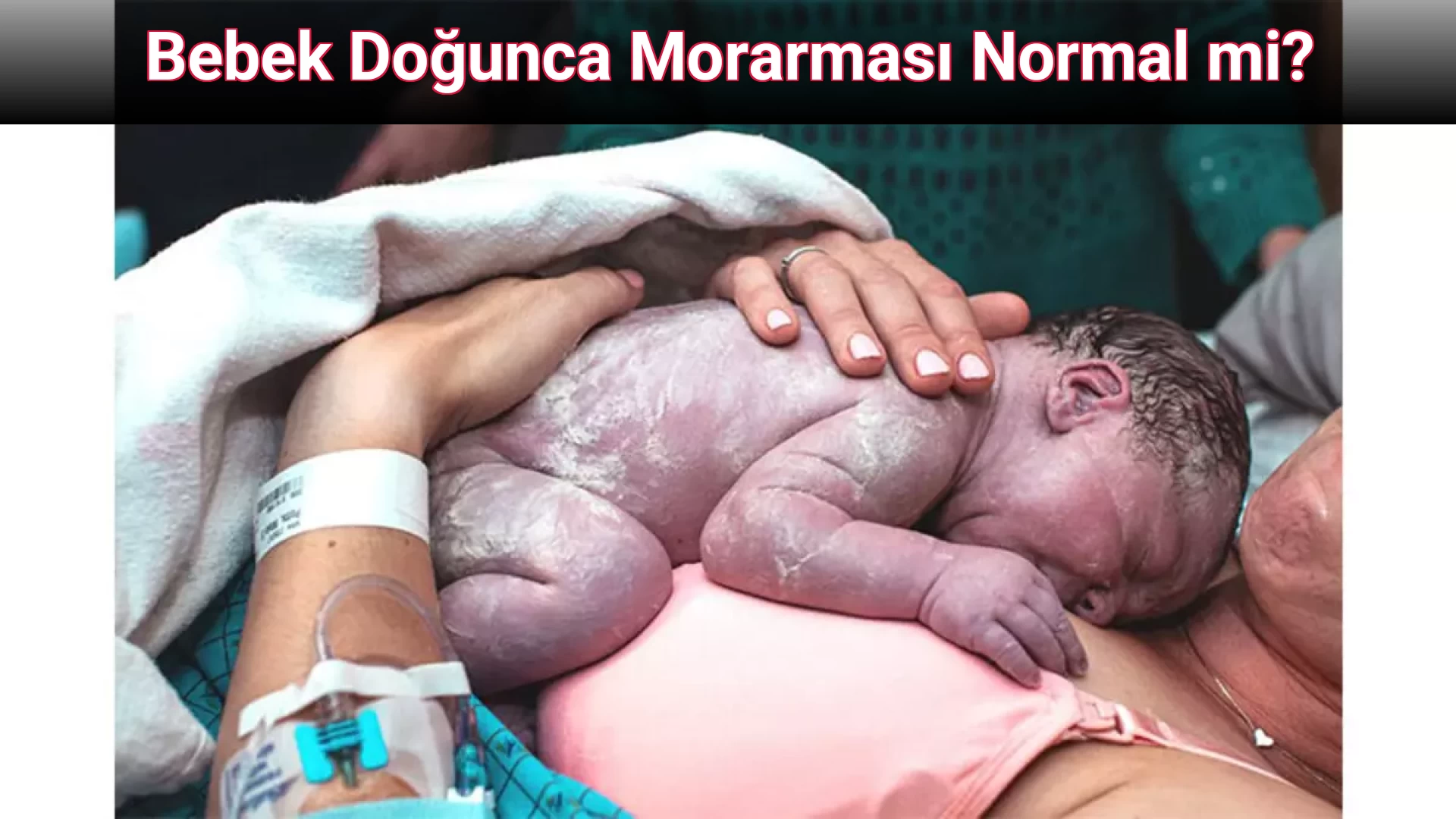 Bebek Doğunca Morarması Normal mi?
